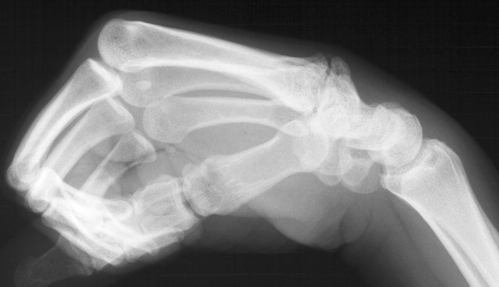 Arthritis Carpometacarpal Boss