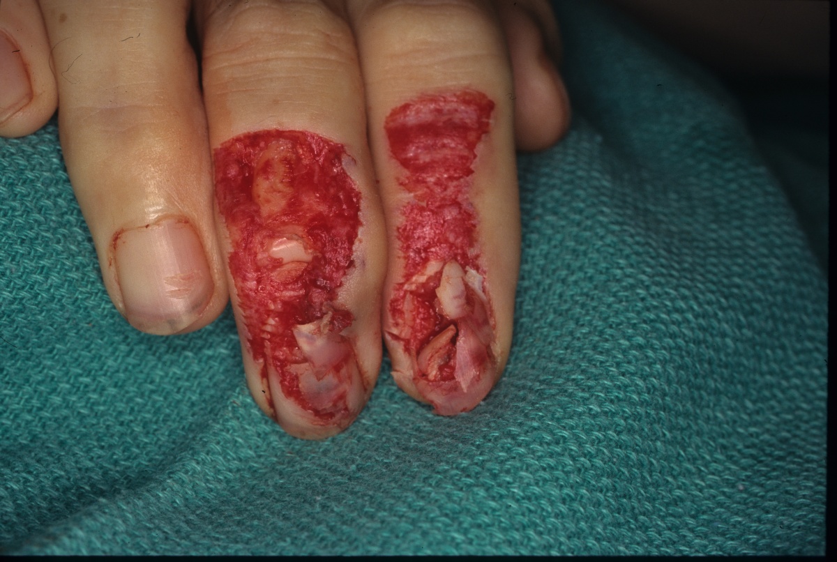 skinsight - Common Nail Problems