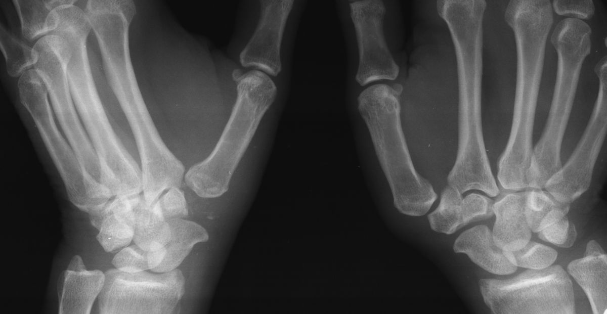 arthritis-basal-joint-arthroplasty-with-tendon-loop-suspension