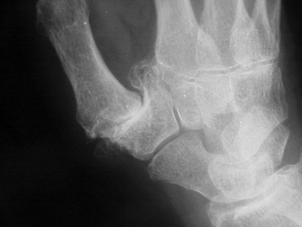 basilar joint arthritis