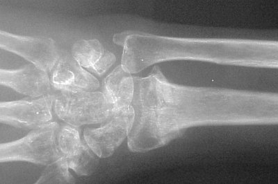 Corrective Osteotomy Distal Radius Malunion