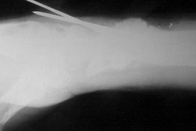 Corrective Osteotomy Distal Radius Malunion