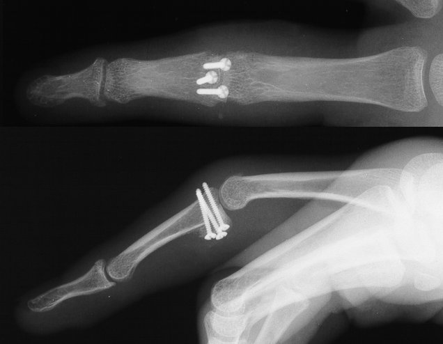Reconstruction: Hamate osteochondral graft for PIP fracture dislocation