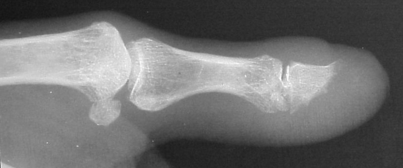 Ногтевая фаланга стопы. Остеолизис костей фаланг. Остеолизис костей на рентгене. Остеолизис ногтевых фаланг. Остеомиелит кости ногтевой фаланги.